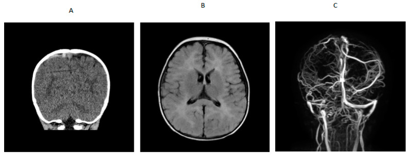 (A) CT scan showing venous hyperdense cortical vein over right parietal convexity. (B) MRI showing extensive white matter changes. (C) MRV showing thrombosis of right parietal cortical vein extending into the superior sagittal sinus.